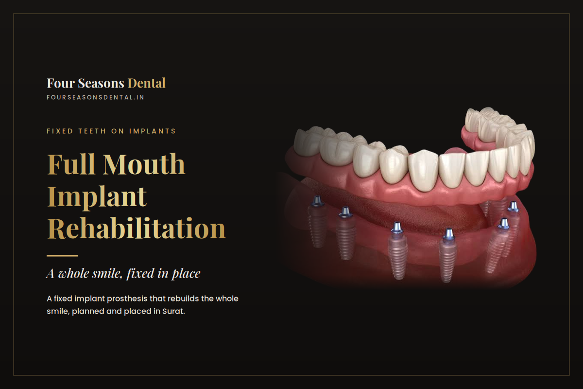 Full mouth implant rehabilitation showing a fixed set of teeth supported by dental implants, Four Seasons Dental, Surat