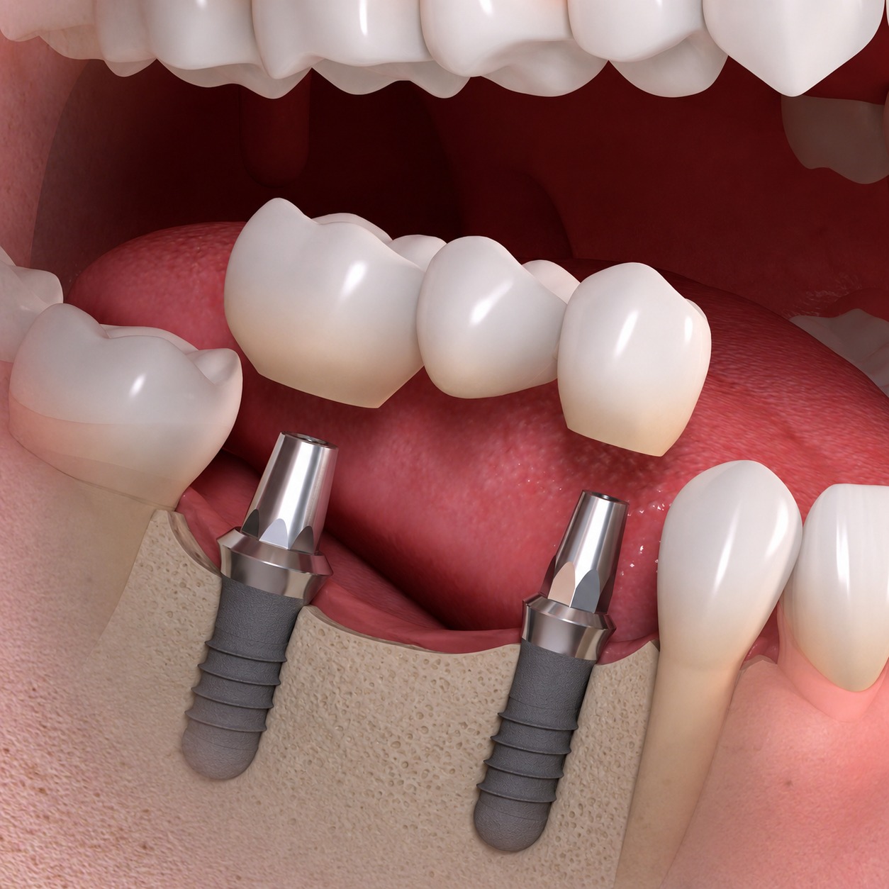 Dental Implants Permanent Tooth Replacement at Four Seasons Dental Surat