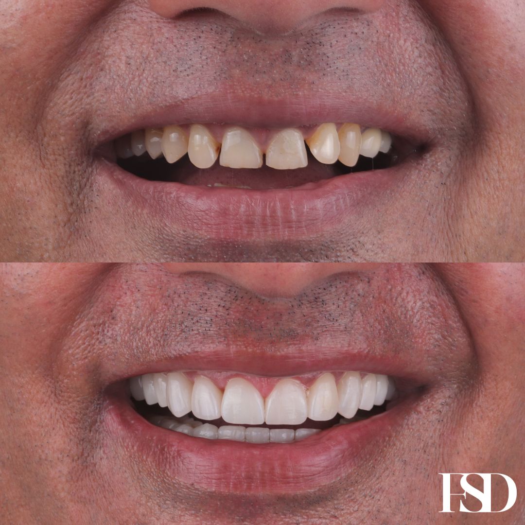 IntraOral