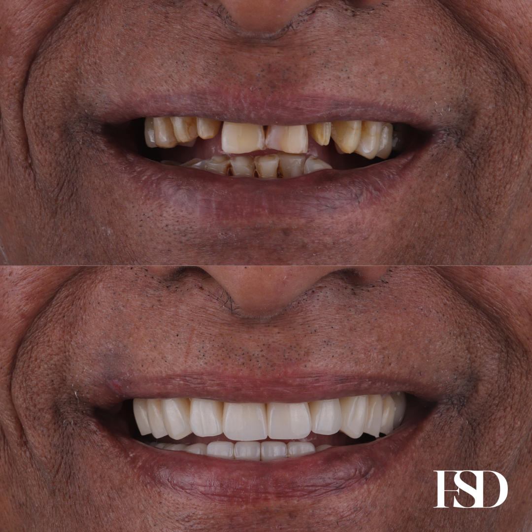 IntraOral