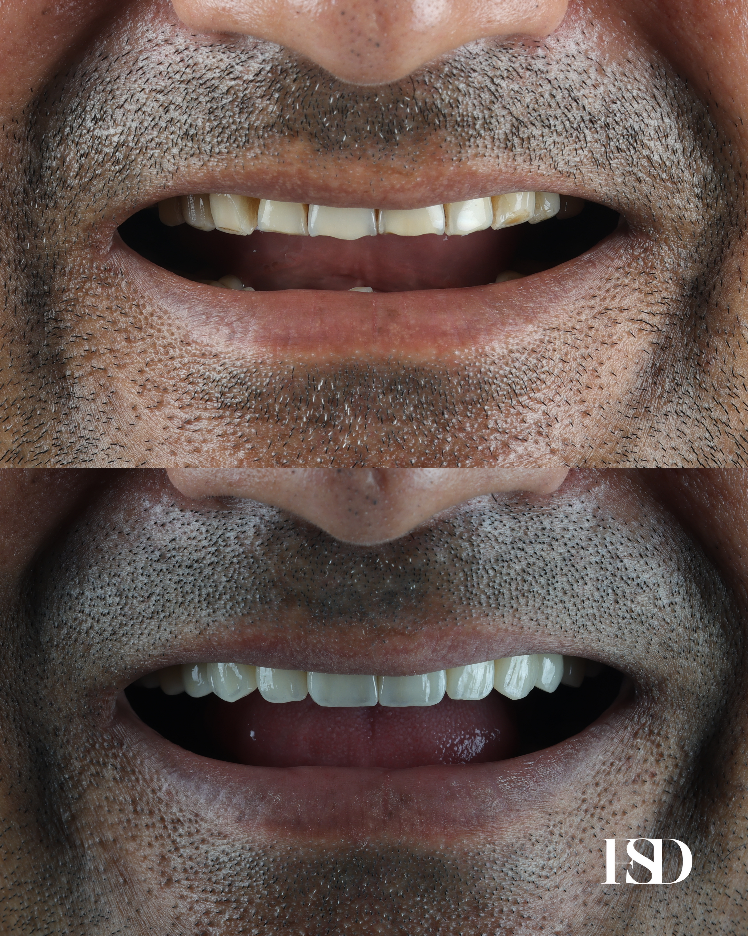 IntraOral