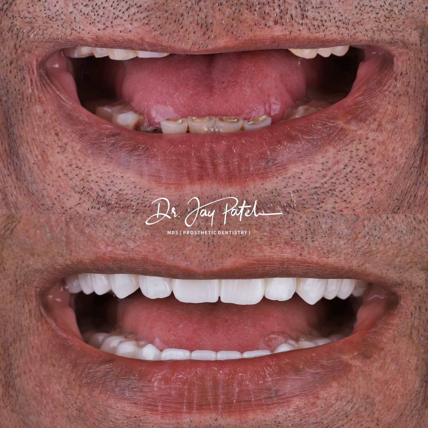 IntraOral