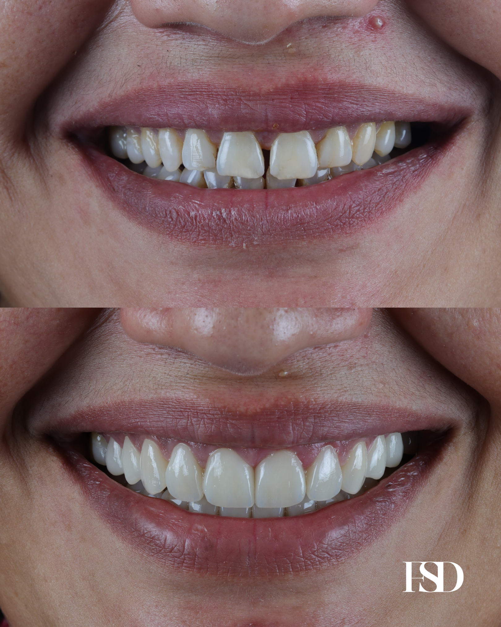 IntraOral