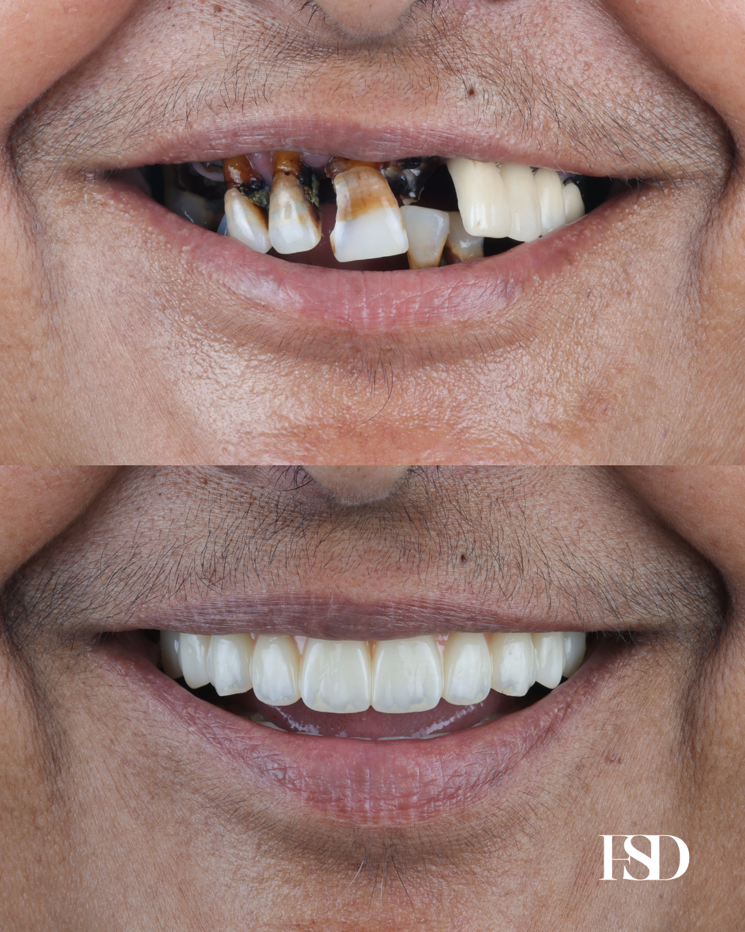 IntraOral