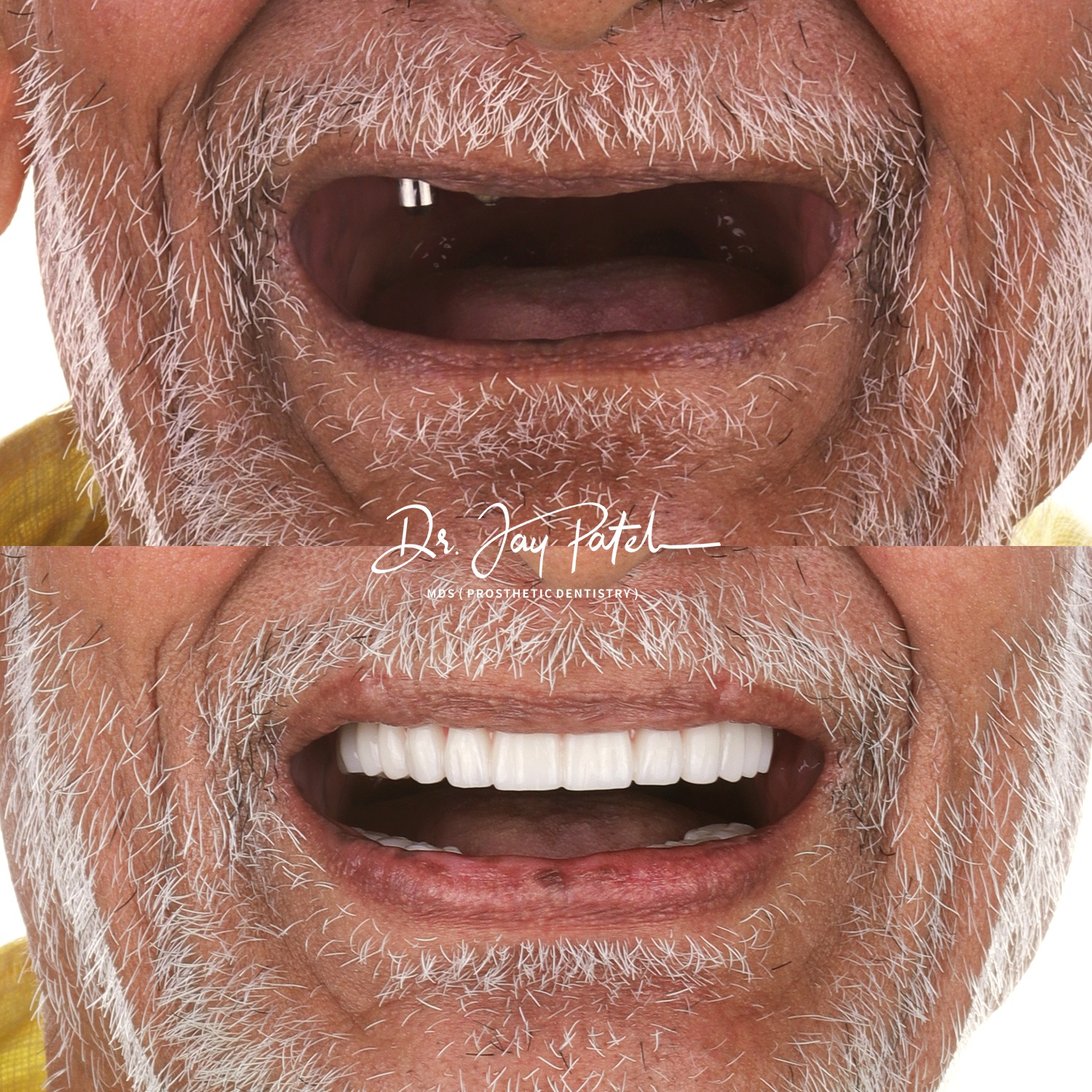 IntraOral