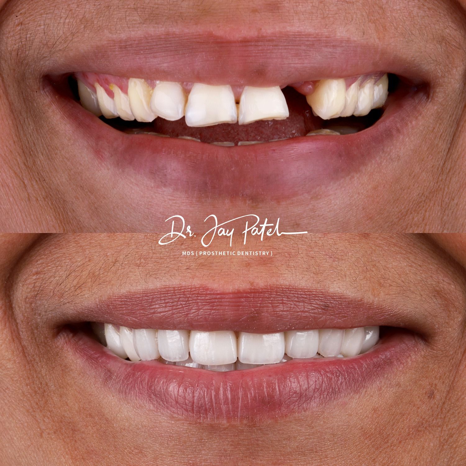 IntraOral