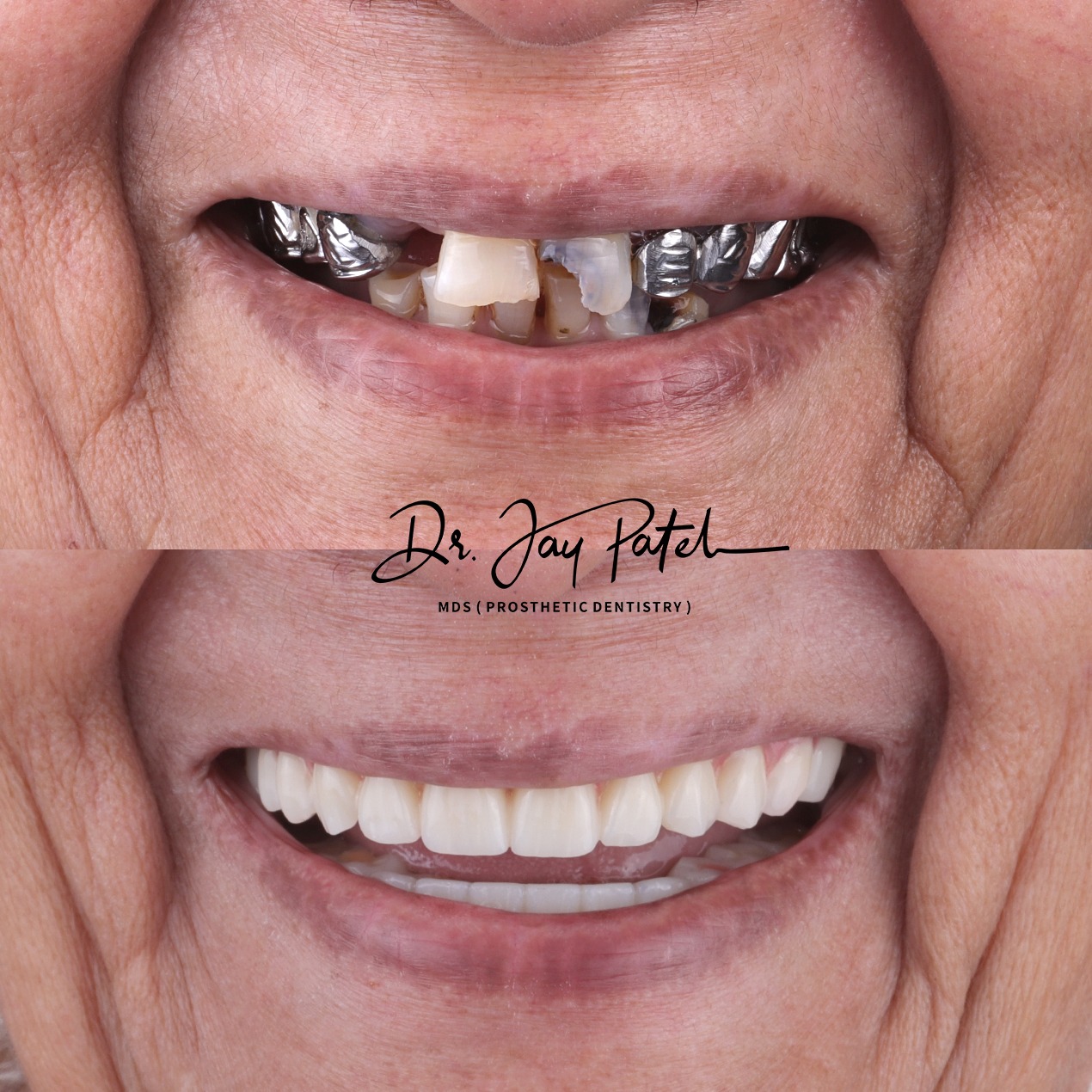 IntraOral