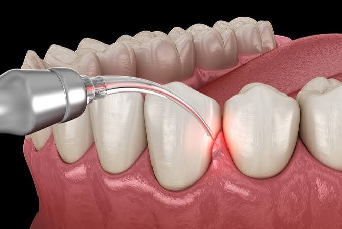 Laser Dentistry at Four Seasons Dental Surat
