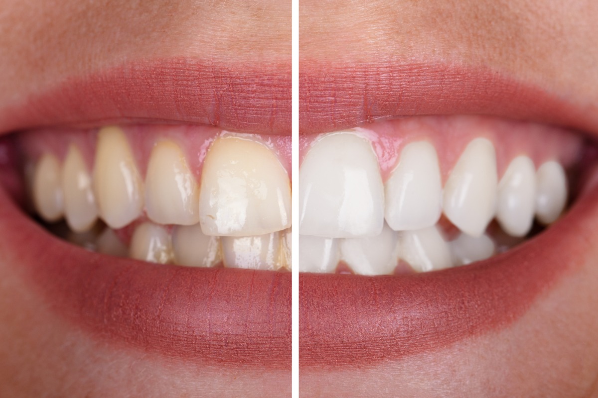 What is Professional Teeth Whitening