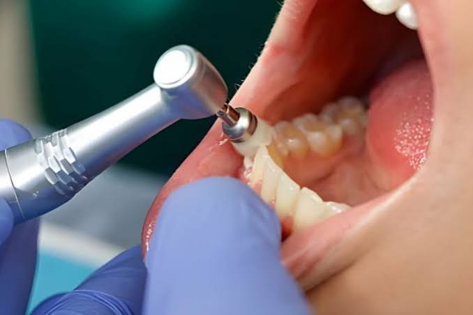 Scaling and polishing at Four Seasons Dental Surat